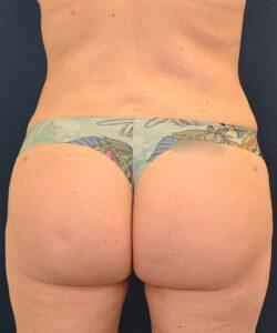 Brazilian Butt Lift for Palm Desert & Palm Springs